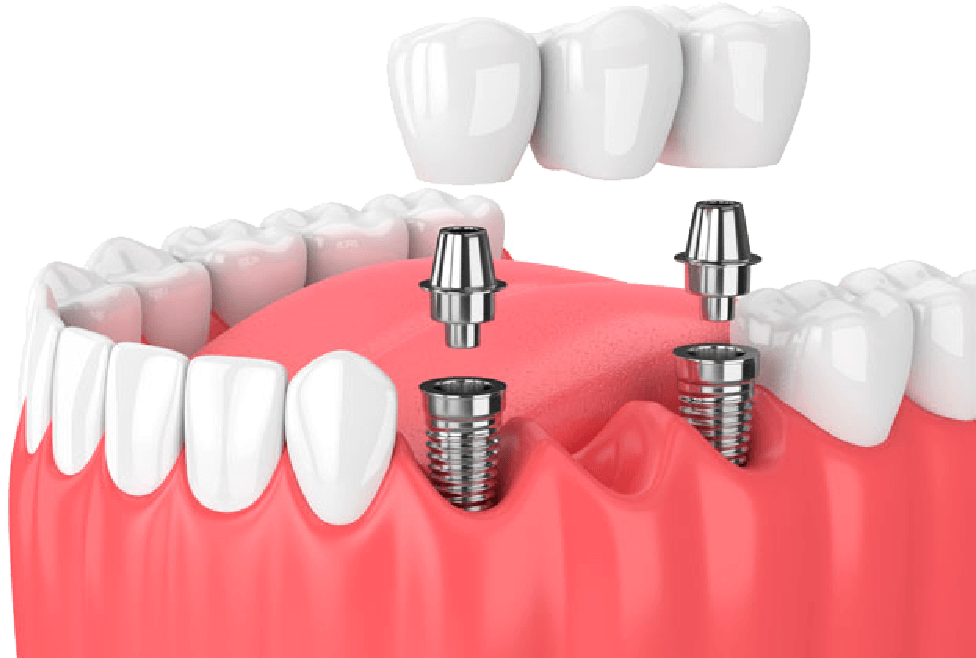 Implante convencional - Prótesis Dentales Querétaro