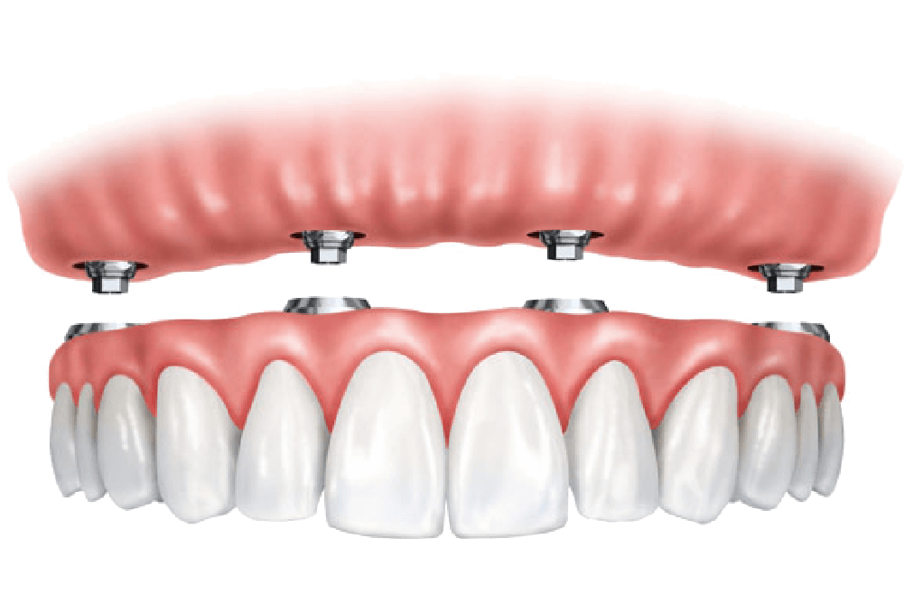 Implantosoportada - Prótesis Dentales Querétaro