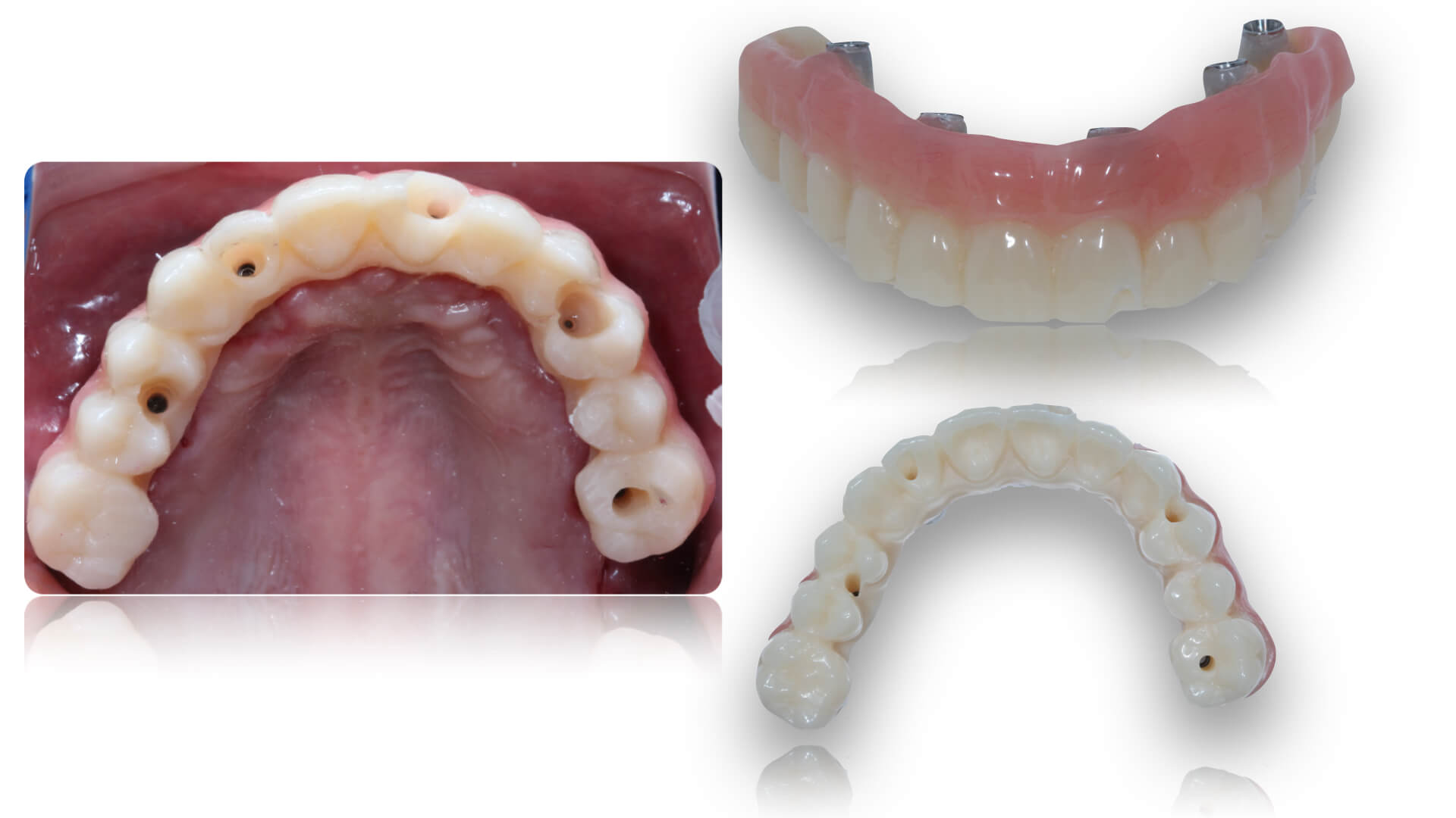 En este momento estás viendo Proceso de aplicación para implantes dentales